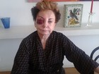 Beatriz Segall sofre queda em rua esburacada e fica com olho roxo