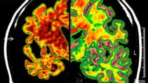 Foto de escaneamento de cérebro de paciente com Alzheimer (Foto: SPL/BBC)