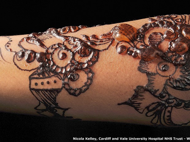 'Aqui você pode ver uma tatuagem em henna negra no antebraço de uma jovem que teve uma reação alérgica à tinta", explicou Dirk Pilat, diretor médico de aprendizado virtual no Royal College para clínicos-gerais, na Grã-Bretanha. "Com uma bela iluminação mo (Foto: Nicola Kelley, Cardiff and Vale University Hospital NHS Trust)
