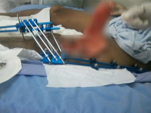 Gaze teve de ser retirada da perna do paciente em cirugia; médico disse à esposa do paciente que era 'normal' deixar gaze no ferimento para ajudar a estancar o sangue (Foto: Arquivo pessoal)
