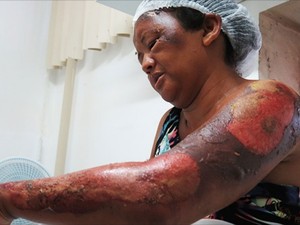 Deuzilene da Silva teve queimaduras pelo corpo em atentado em Mossoró (Foto: Josemário Alves/Mossoró Hoje)