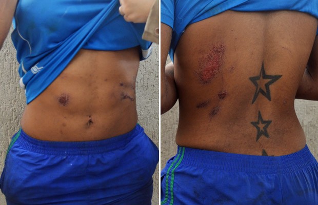 Feridas e hematomas são vistos na barriga e nas costas de Verônica Bolina (Foto: Divulgação)