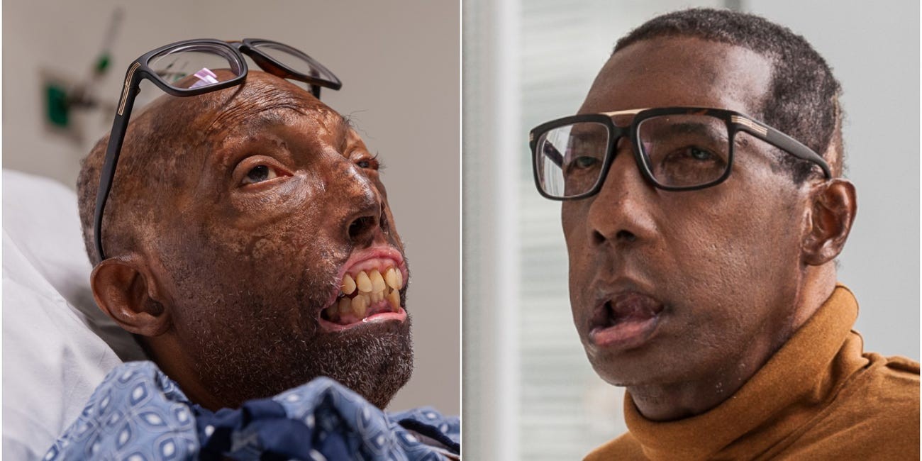 Robert Chelsea, de 68 anos, antes e depois de receber transplante facial completo (Foto: Lightchaser Photography / J. Kiely Jr./BRIGHAM AND WOMEN'S HOSPITAL)