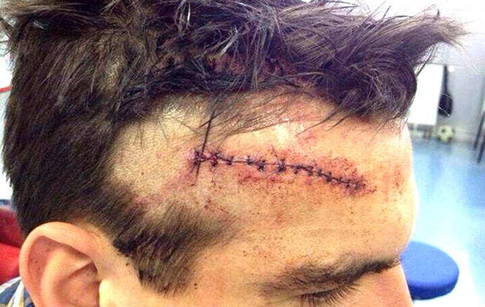 Jogador do Mainz 05 mostra estrago feito na cabeça por pé muito alto de