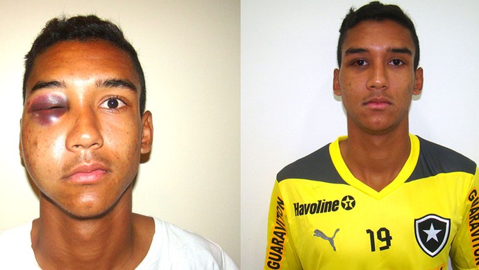 Verdini zagueiro Botafogo recuperação  fratura do osso zigomático (Foto: Divulgação])