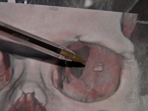 Exames mostra localização do pedaço de metal no olho esquerdo de Elias Sampaio (Foto: Reprodução/TVCA)