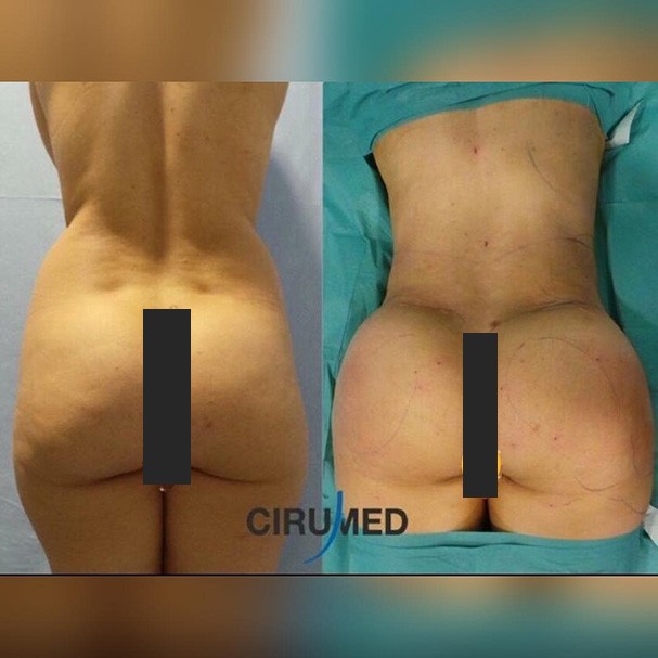 Brazilian Butt Lift (Foto: Reprodução/Instagram)