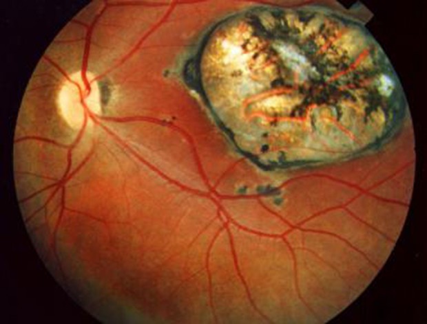 Cicatriz macular devido Toxoplasmose Ocular