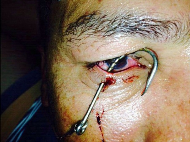 Homem fica com anzol preso no olho em um acidente durante uma pescaria (Foto: Julio Lossio / Arquivo Pessoal)