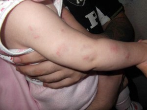Criança está cheia de hematomas no braço (Foto: David Gomes/Arquivo Pessoal)