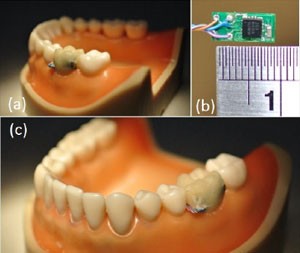 Sensor colocado em dente pode monitorar hábitos do usuário (Foto: Divulgação/National Taiwan University)
