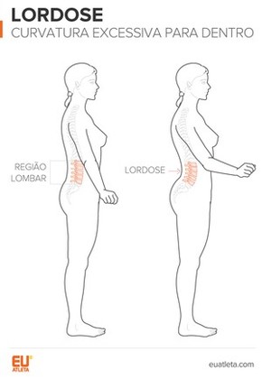 Lordose Cifose E Escoliose Os Desvios Na Coluna E A Relacao Com Exercicios Saude Globoesporte Com