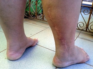 Jovem tirou nervo do pé para colocar no braço, após acidente em Limeira (Foto: Fernanda Zanetti/G1)