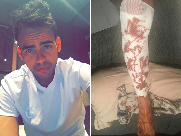 O brasileiro Anderson Happel, que foi ferido pelo caminhão do atentado de Nice; à dir., a perna ensanguentada dele (Foto: Arquivo pessoal/Anderson Happel)