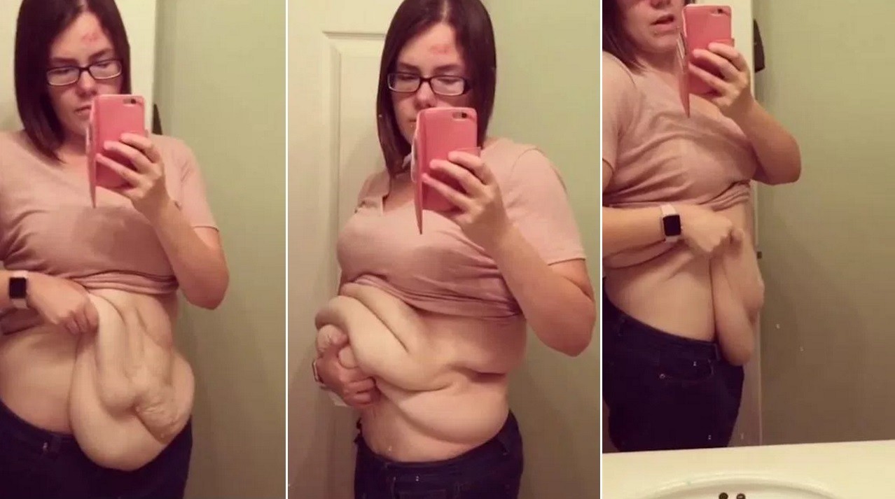 Amanda e o resultado do emagrecimento extremo após cirurgia de redução de estômago