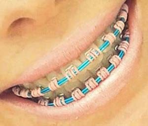 Jovens usam acessórios dentários de maneira irregular (Foto: Aparelhos Diferenciados/Divulgação/Facebook)