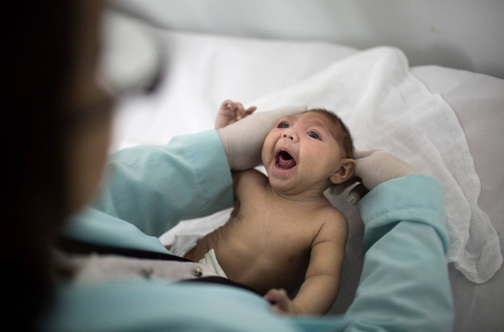 Criança com microcefalia (Foto: Felipe Dana/AP)