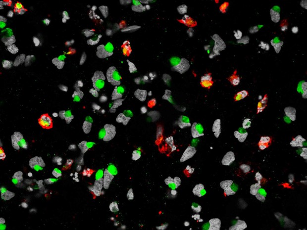  Imagem mostra a proteína envelope do vírus da zika (em verde) atacando os núcleos das células progenitoras neurais  (em branco e cinza)  (Foto: Sarah C. Ogden)