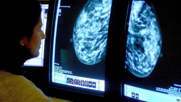 Entidades que combatem câncer de mama não recomendam uso de estatina e pedem mais estudos (Foto: PA/BBC)