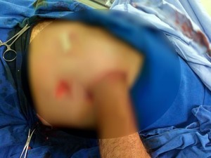 Paciente ficará seis semanas com a mão dentro do abdomen (Foto: Fundação Hospitalar Santa Otília/Divulgação)