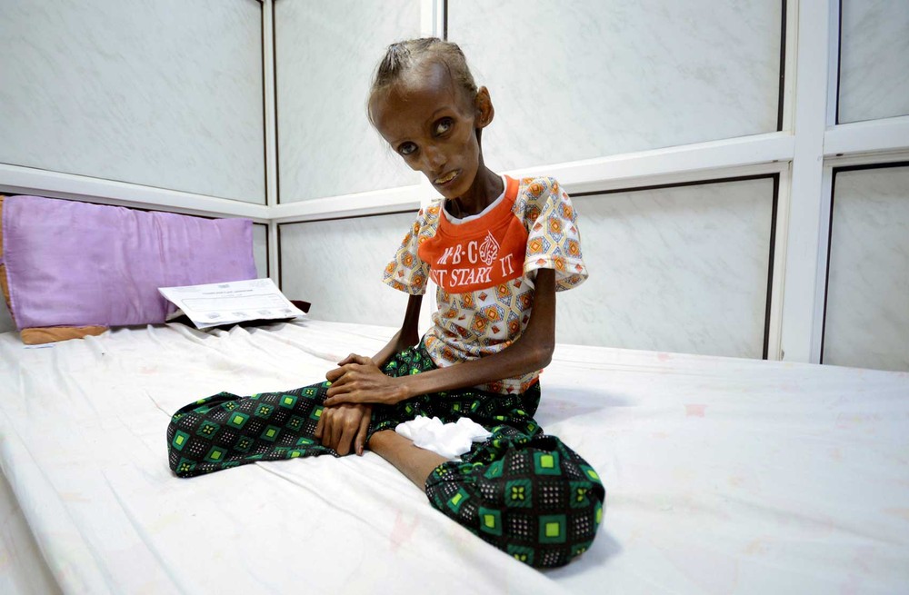 Saida Ahmad Baghili, de 18 anos, sofre de desnutrição severa. A foto foi tirada no hospital da cidade de Hodeidah, no Iêmen, em 24 de outubro (Foto: Abduljabbar Zeyad/ Reuters)