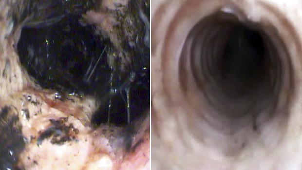 Imagens mostram o pulmão antes e depois da limpeza realizada com o broncoscópio (Foto: Reprodução/RBS TV)