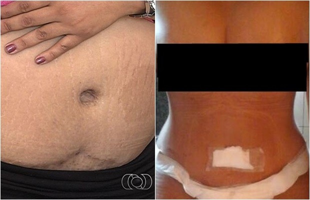 Imagens mostram resultado da primeira cirurgia e agora após novo procedimento, em Goiás (Foto: Arquivo pessoal)