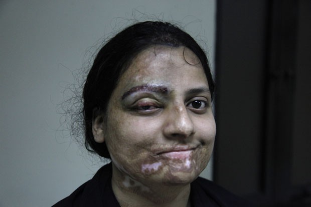 Foto divulgada pela Clínica Crown mostra uma das mulheres que passou por cirurgia após ser vítima de ataque de ácido no Paquistão (Foto: Shakil Adil/AP Images for Crown Clinic)
