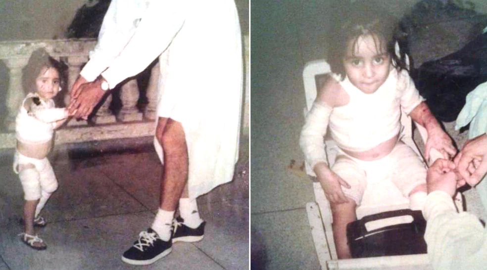 Isabela ficou com 75% do corpo queimado após o acidente em Santos, SP (Foto: Arquivo Pessoal )