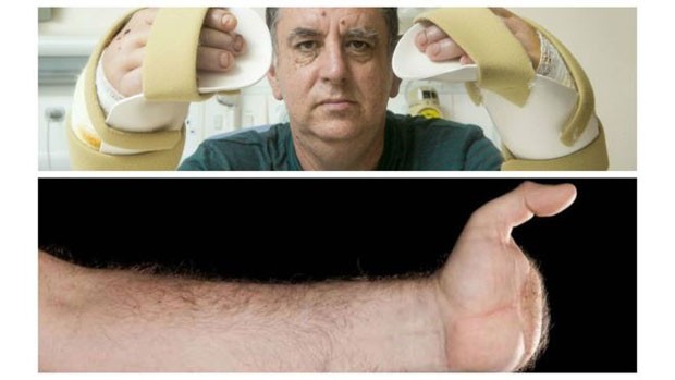 Acima, Chris King depois do transplante duplo; abaixo, a mão esquerda dele antes da cirurgia (Foto: Leeds Teaching Hospitals NHS Trust)