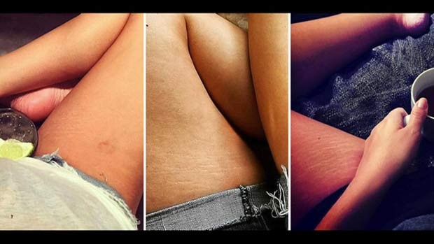 Mulheres postam fotos de estrias e celulites para promover corpos 'normais' (Foto: BBC)