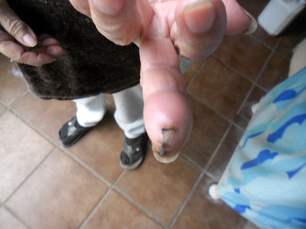 Aposentada exibe dedo com os pontos após objeto ser removido (Foto: Josimar Inácio Figueiredo/VC no G1)