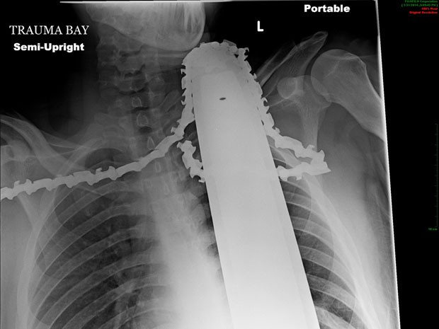 Raio-X mostra serra elétrica ainda no pescoço de James Valentine (Foto: AP Photo/Allegheny Health Network)