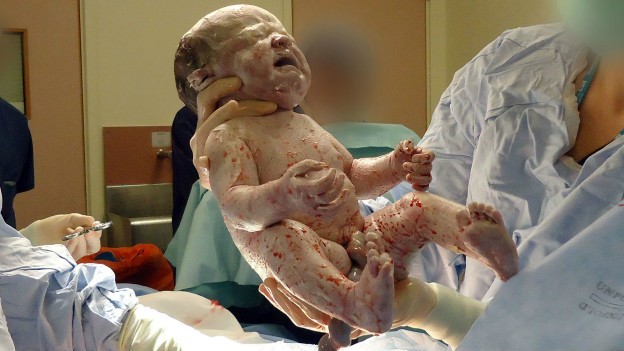 Bebê nascido em cesárea; a cesariana é um recurso importante para salvar vidas, mas não deve ser feita desnecessariamente (Foto: BBC)