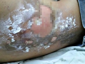 Após ser atingido por raio, jovem ficou com queimaduras nas costas e pernas (Foto: Edmar Negreiros/Arquivo Pessoal)