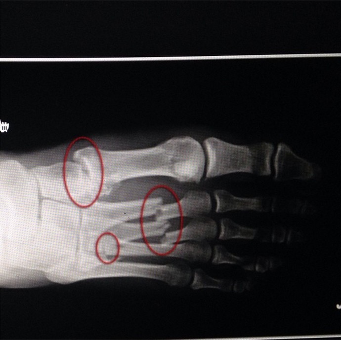 Tyron Woodley Revela Que Fraturou O Pe Em Luta Contra Gastelum Veja Raio X Blog Ultimmato Globoesporte Com