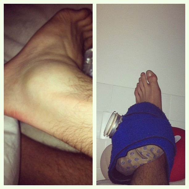 Bruninho mostra tornozelo inchado vôlei (Foto: Reprodução/Instagram)