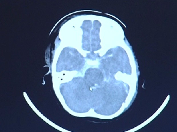 Menina teve hemorragia em várias áreas do cérebro que impossibilita cirurgia. (Foto: Reprodução/ Tv Tem)