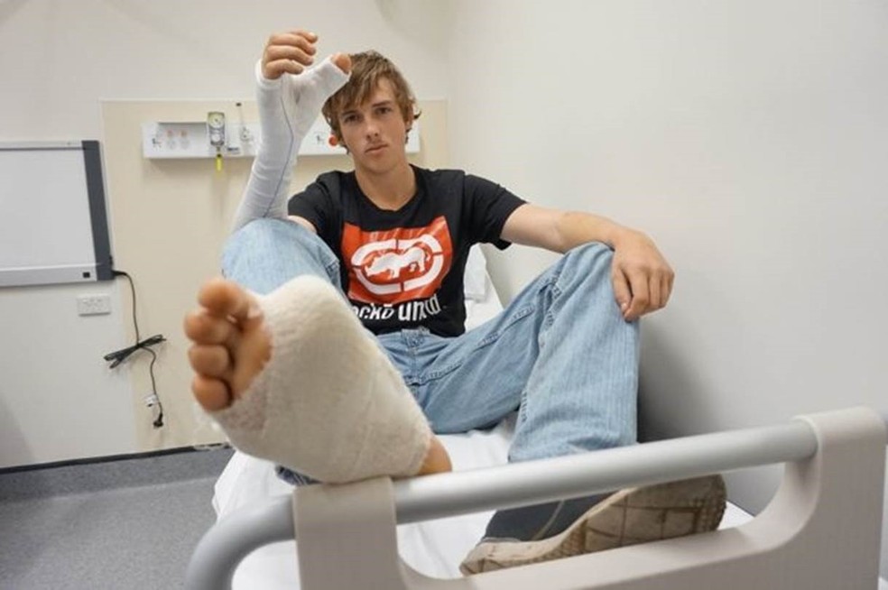 Zac Mitchell's teve o dedão do pé enxertado em sua mão direita (Foto: South Eastern Sydney Local Health District)