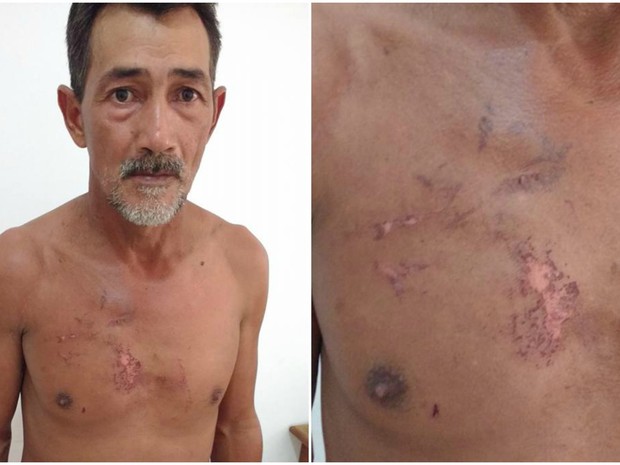 Agricultor ficou com marcas no peito após ser atingido por raio  (Foto: Aldejane Pinto/Arquivo pessoal )