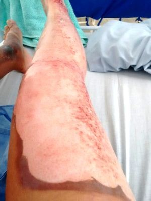 Mulher ficou sem a primeira cama da pele (Foto: G1) Mulher ficou sem a primeira cama da pele (Foto: G1)