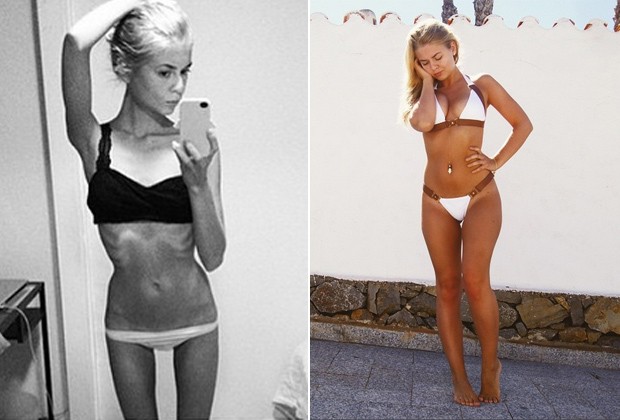 Amalie Lee, de 20 anos, foi diagnosticada com anorexia em 2012 (Foto: Reprodução Instagram)