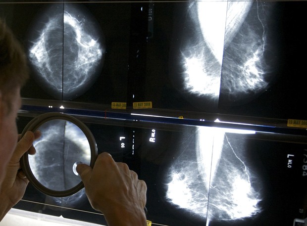 Radiologista observa mamograma de paciente em Los Angeles (Foto: AP Photo/Damian Dovarganes, File)