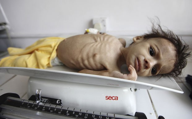 G1 Fotos Em Hospital Da Capital Do Iêmen Mostram Subnutrição Infantil Notícias Em Revolta Árabe 