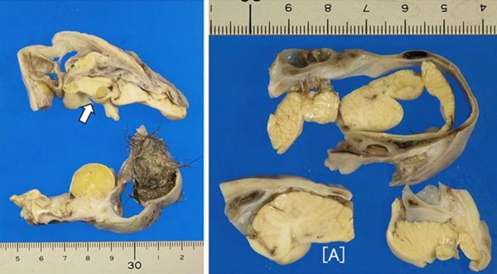 Imagens do tumor, que tinha pelos e uma estrutura em forma de cérebro de 3cm coberta por uma placa de osso craniano (Foto: Masayuki Shintaku)