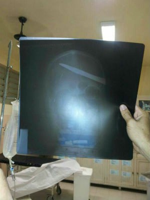 Radiografia mostra a faca no crânio da vítima (Foto: Polícia Militar/Divulgação)
