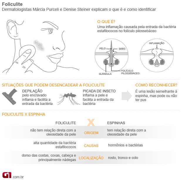 Bem Estar - Infográfico explica como identificar a foliculite (Foto: Arte/G1)