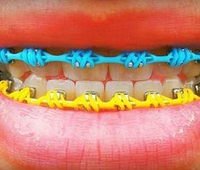 Aparelho Dentario Irregular Pode Causar Ate Perda De Dente Diz Dentista Bem Estar G1 Iniciar o tratamento já fará com que você perceba. g1 globo
