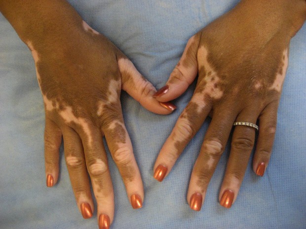 Mãos de paciente com vitiligo, que apresentam manchas brancas (Foto: John E. Harris, MD, PhD/Divulgação  )