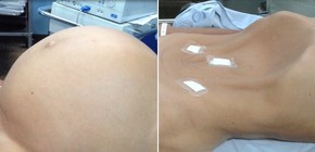 Hc Retira Cisto Gigante De Ovario Por Cirurgia Minimamente Invasiva Bem Estar G1